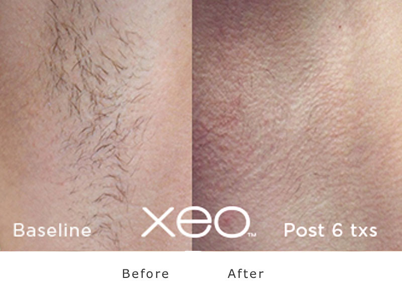 cutera XEO laser hair removal face before and after