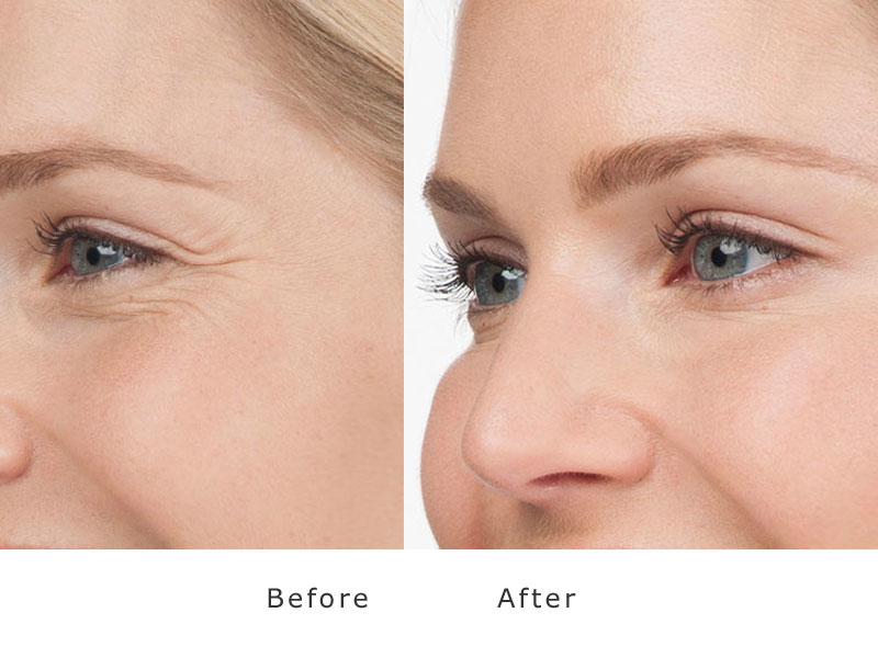 Botox Treatment Areas performed at My Face Aesthetics Clinic Bolton