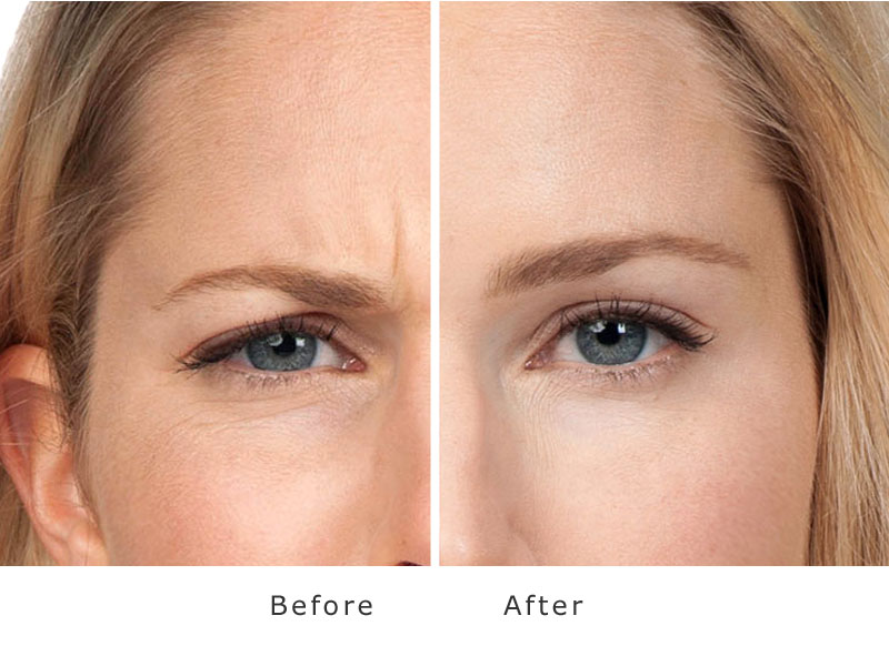 face results before and after treatment of anti wrinkle injections