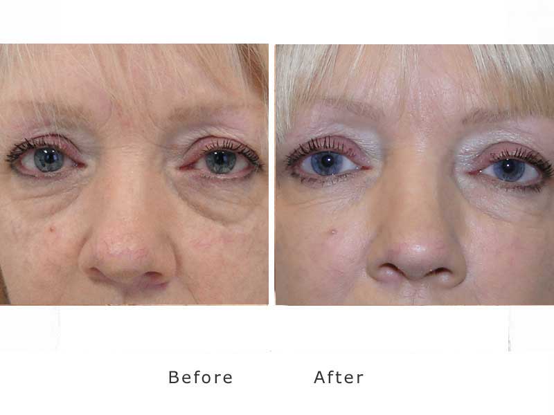 restoring volume to dark hollow eyes using dermal fillers
