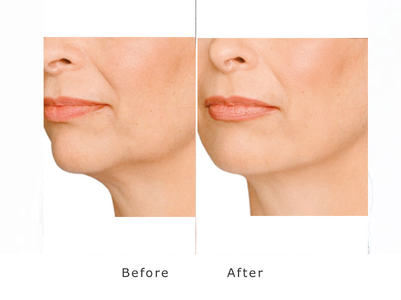 deral filler showing improvement to jowl and jawline