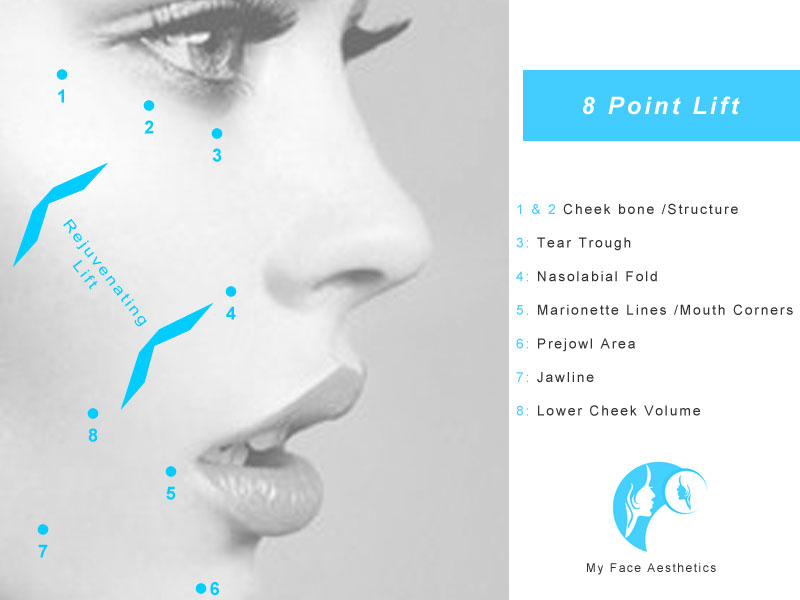 8 point face lift treatment areas