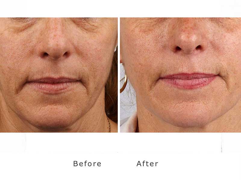 dermal filler showing improvement to jowl and jawline on a woman