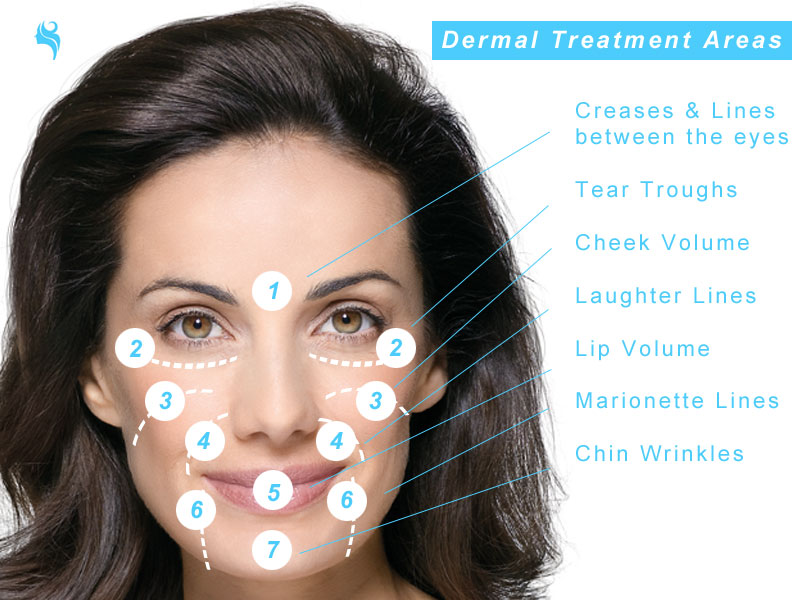 dermal fillers treatment areas