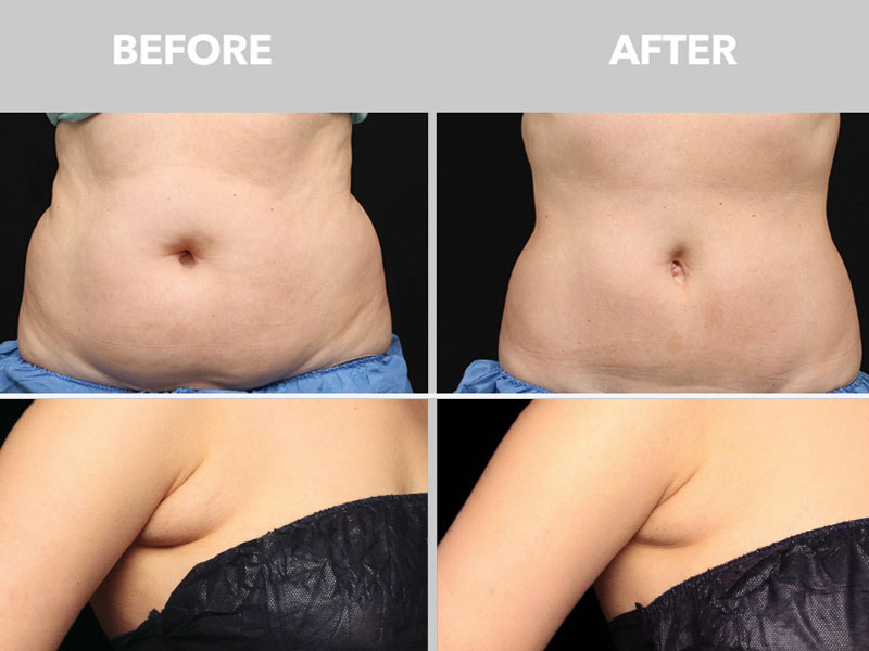 Cryolipolysis Fat Freezing Treatments