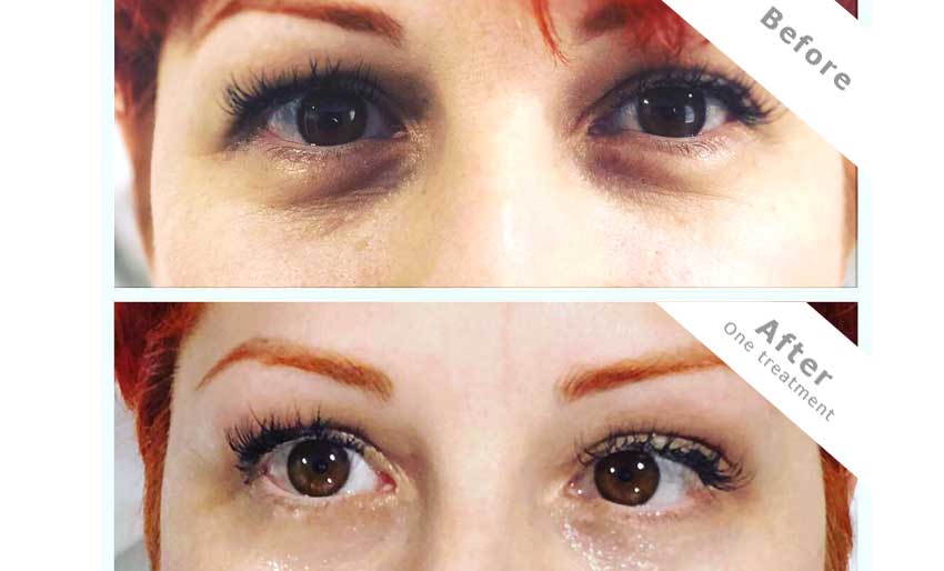 ageing eye area treatment using iridium cONTOUR BEFORE AND AFTER EYE TREAMENT PHOTOGRAPH