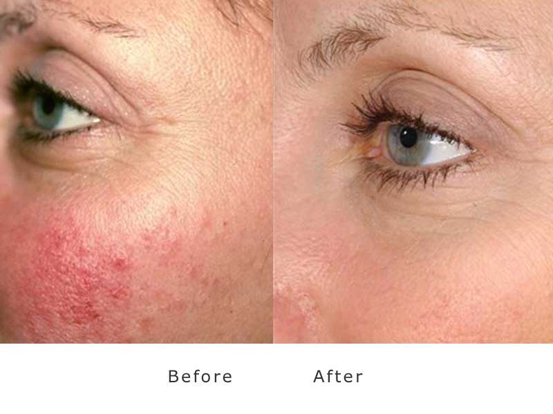 rosacea treated after 3 visits