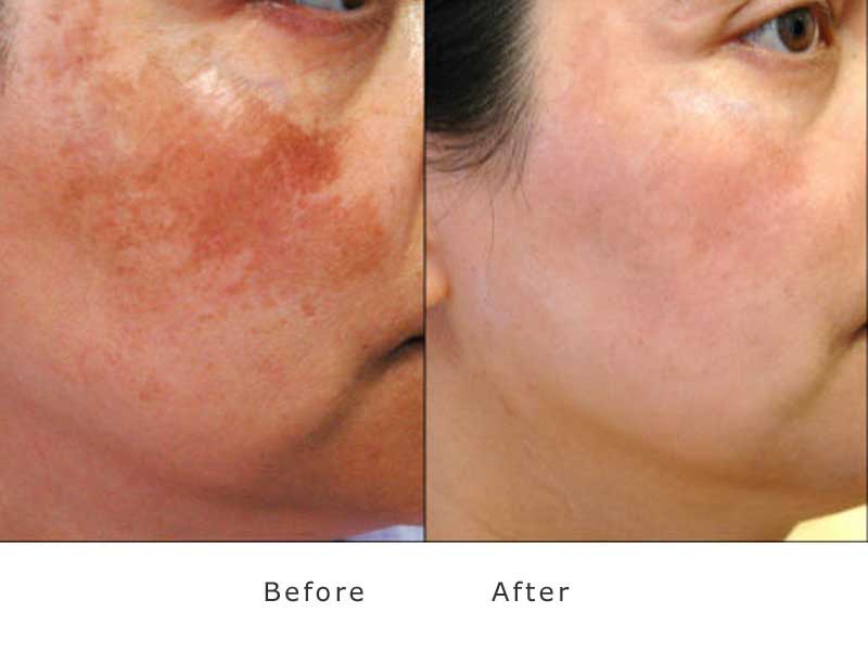 Rosacea And Acne Treatment At My Face Aesthetics Laser Clinic Bolton