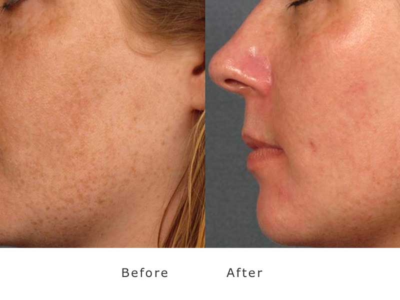 limelight laser treatment to facial rosacea