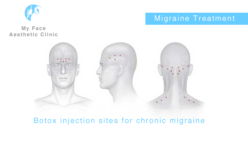 areas treated by botox injectections to cure migraines