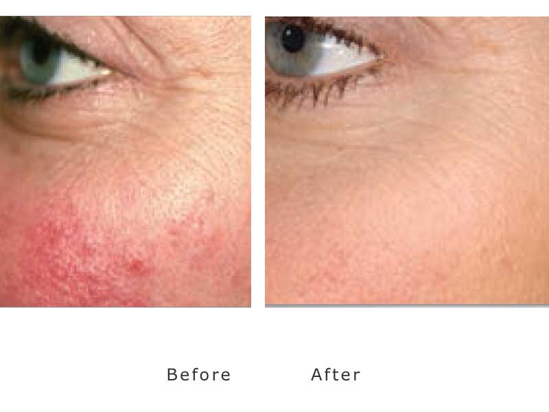 diffuse redness to cheaks treated by cutera genesis lasers in our clinic