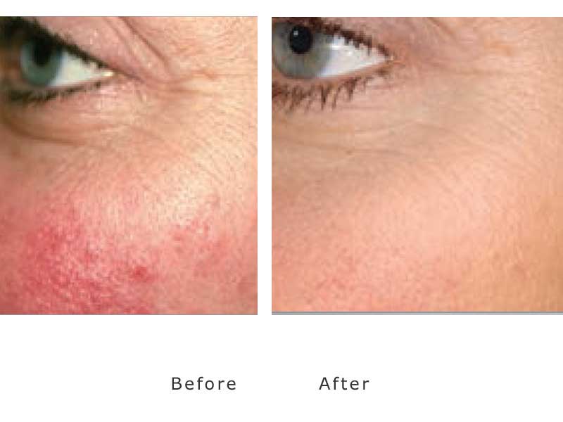Skin Rejuvenation Laser treatments at My Face Aesthetics Bolton
