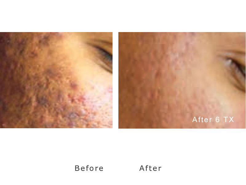 acne-laser-treatment