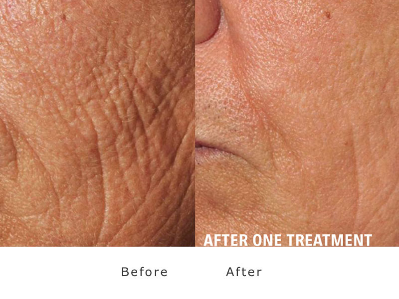 resurfacing of the skin with laser sample1