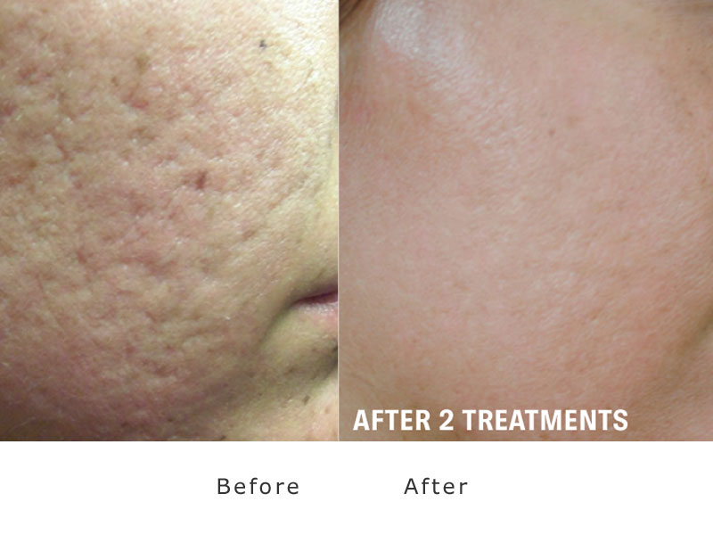 skin improvement sample 1 treatment of xeo lasering