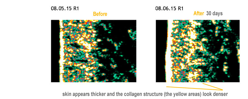 skin improvement example after 30 days of taking skinade collagen drink the skin appears thicker and the collagen has increased